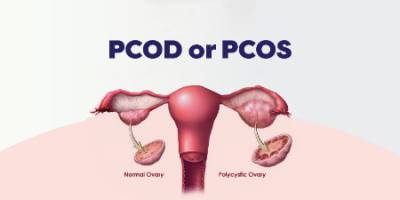 تفاوت pcod و pcos, pcos چيست