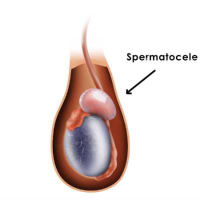 کیست اپیدیدیم یا اسپرماتوسل, کیست اپیدیدیم