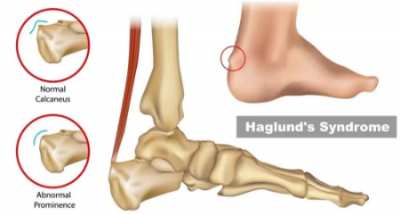 بیماری هاگلند؛ علت ایجاد برآمدگی پشت پاشنه و راه‌های درمان آن
