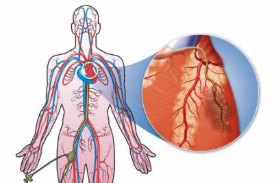 کاتتریزاسیون قلبی, کاتتر قلبی چیست